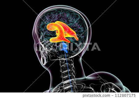 Enlarged lateral and third ventricles of the brain, 3D illustration Enlarged lateral and third ventricles of the brain, 3D illustration 112807175