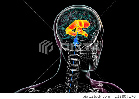 Enlarged lateral and third ventricles of the brain, 3D illustration Enlarged lateral and third ventricles of the brain, 3D illustration 112807176