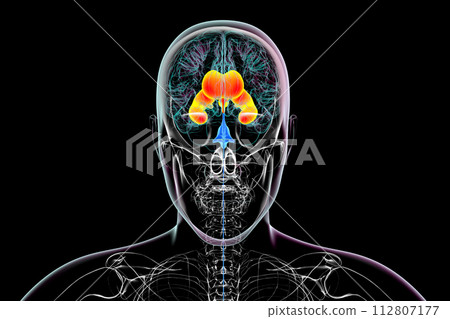 Enlarged lateral and third ventricles of the brain, 3D illustration Enlarged lateral and third ventricles of the brain, 3D illustration 112807177