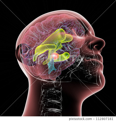 A brain tumor causing hydrocephalus, 3D illustration 112807181