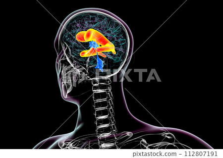 Enlarged lateral ventricles of the brain, 3D illustration Enlarged lateral ventricles of the brain, 3D illustration 112807191