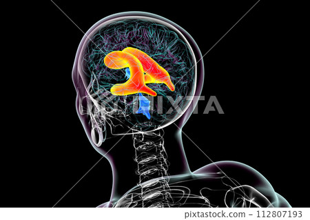 Enlarged lateral ventricles of the brain, 3D illustration Enlarged lateral ventricles of the brain, 3D illustration 112807193