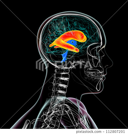 Enlarged lateral ventricles of the brain, 3D illustration 112807201