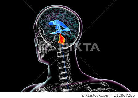 Enlargement of the fourth brain ventricle, 3D illustration 112807299