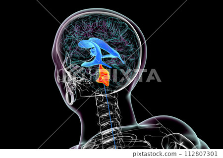 Enlargement of the fourth brain ventricle, 3D illustration Enlargement of the fourth brain ventricle, 3D illustration 112807301