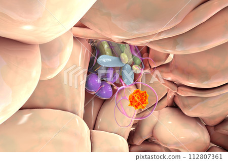 A pituitary gland tumor, 3D illustration 112807361