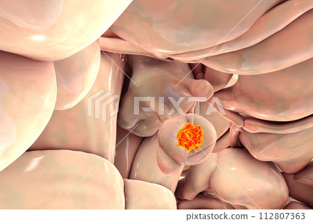 A pituitary gland tumor, 3D illustration 112807363