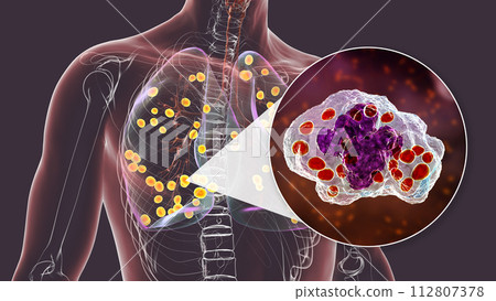 Lung histoplasmosis, a fungal infection caused by Histoplasma capsulatum, 3D illustration 112807378