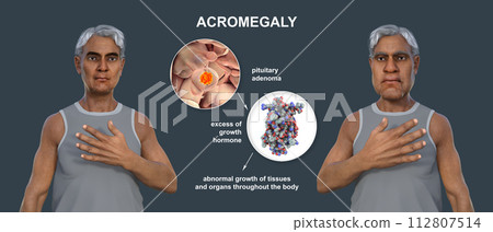 Acromegaly, 3D illustration Acromegaly, 3D illustration 112807514
