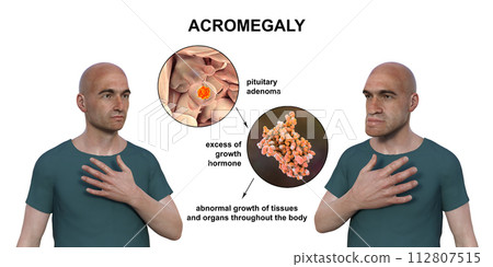 Acromegaly, 3D illustration 112807515