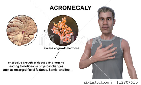 Acromegaly, 3D illustration 112807519