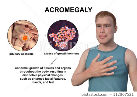Acromegaly, 3D illustration Acromegaly, 3D illustration 112807521