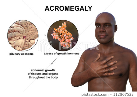 Acromegaly, 3D illustration 112807522