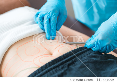 進行抽脂手術的美容外科醫生/美容外科醫生 進行抽脂手術的美容外科醫生/美容外科醫生 112824096