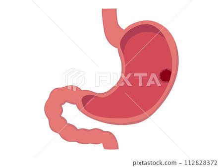 Stomach with gastric cancer tumor 112828372