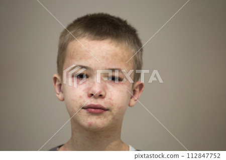Portrait of sick sad boy child suffering from measles or chicken pox with bumps all over face. Contagious child diseases and treatment. Portrait of sick sad boy child suffering from measles or chicken pox with bumps all over face. Contagious child diseases and treatment. 112847752