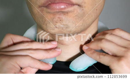 A person who wraps a cold pack around his neck 112853699