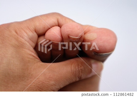 跑完馬拉松後腳底起水泡 112861482