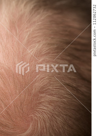 Macro shot of hair loss problem of blonde man hair closeup 112862732