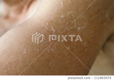 因曬傷而脫皮的手臂特寫 因曬傷而脫皮的手臂特寫 112863074