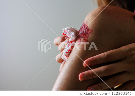 A woman caring for her bleeding knee (no face) 112863145