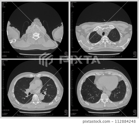 CT examination image CT examination image 112884248