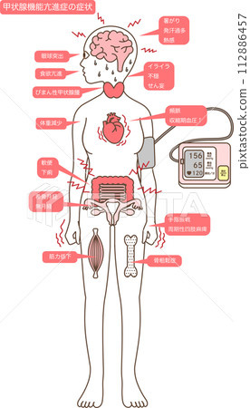 甲狀腺功能亢進的症狀 112886457