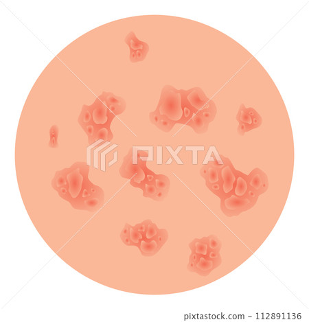 Type of psoriasis vector. Part of patients skin with dermatitis, inflammation, red rash and other skin problems. Cartoon illustration for disease concept 112891136