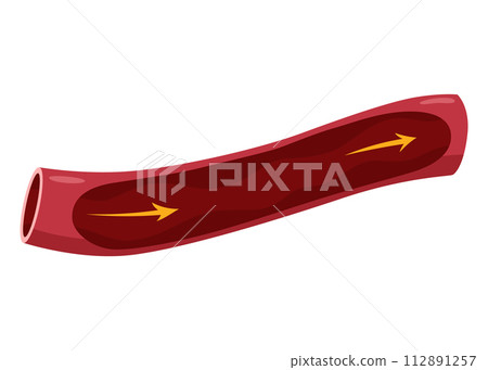 Atherosclerosis stage. Anatomy of heart attack. Arteriosclerotic vascular disease or ASVD. Atherosclerotic plaque in coronary artery. Vector illustration on white background 112891257