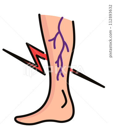 Varicose treatment icon. Violation of circulatory system. Vascular disease diagnostic. Venous insufficiency medical disease. Vector illustration 112893632