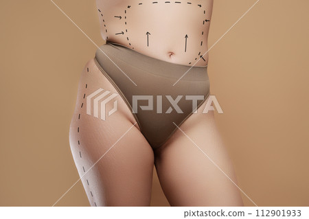 liposuction, fat and cellulite removal. Lifting liposuction, fat and cellulite removal. Lifting 112901933