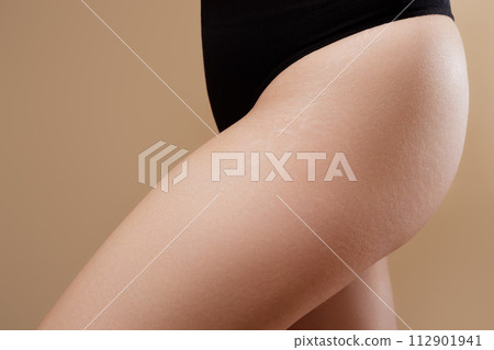 Close up female thighs with stretch marks. Stretch Close up female thighs with stretch marks. Stretch 112901941