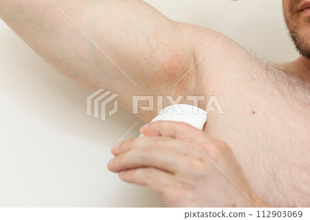 Young man with irritation, inflammation on sensitive underarm skin, using deodorant or antiperspirant for treatment armpit rash. Allergy, atopic dermatitis. Acne or red spots. Healthcare concept Young man with irritation, inflammation on sensitive underarm skin, using deodorant or antiperspirant for treatment armpit rash. Allergy, atopic dermatitis. Acne or red spots. Healthcare concept 112903069