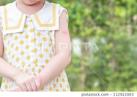 Little girl has skin rash allergy itching and scratching on her arm 112922863