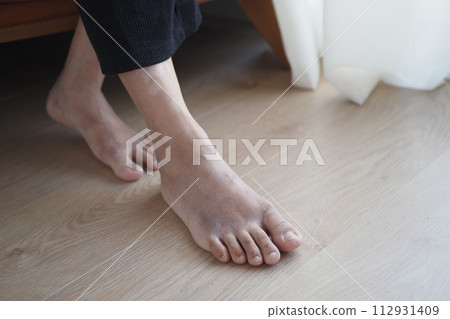 close up of women feet with swelling close up of women feet with swelling 112931409