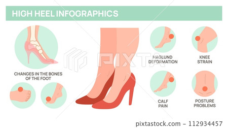 High heels harm for female feet. Foot disease medical poster. Deformity of bones and joints. Orthopedic problem. Uncomfortable woman footgear. Anatomy infographic. Garish vector concept High heels harm for female feet. Foot disease medical poster. Deformity of bones and joints. Orthopedic problem. Uncomfortable woman footgear. Anatomy infographic. Garish vector concept 112934457