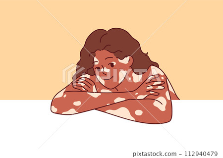 African American woman with vitiligo syndrome and spots on skin, leaning elbows on white surface 112940479