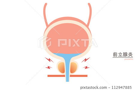 Medical illustration of prostate, prostatitis 112947885