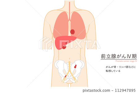 前列腺、前列腺癌 4 期的醫學插圖 前列腺、前列腺癌 4 期的醫學插圖 112947895