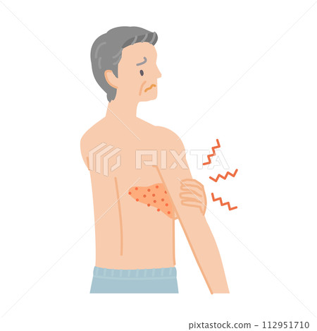 帶狀皰疹:老人從背部到胸部疼痛、搔癢和腫脹(後視圖) 帶狀皰疹:老人從背部到胸部疼痛、搔癢和腫脹(後視圖) 112951710