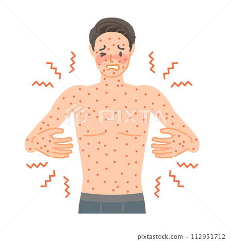 皮疹:一名男子因蕁麻疹而全身搔癢、疼痛。 皮疹:一名男子因蕁麻疹而全身搔癢、疼痛。 112951712