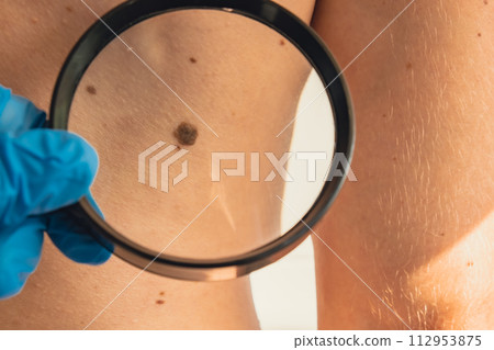 Mole dermoscopy, preventive of melanoma. Dermatologist examining patient's birthmark with magnifying glass in clinic. Checking benign moles. Skin abnormalities care 112953875