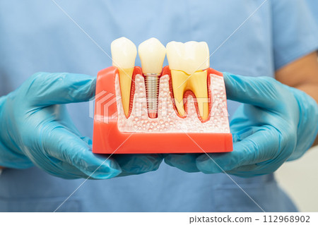 Dental implant, artificial tooth roots into jaw, root canal of dental treatment, gum disease, teeth model for dentist studying about dentistry. Dental implant, artificial tooth roots into jaw, root canal of dental treatment, gum disease, teeth model for dentist studying about dentistry. 112968902