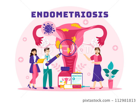 Endometriosis Vector Illustration with Condition the Endometrium Grows Outside the Uterine Wall in Women for Treatment in Flat Cartoon Background Endometriosis Vector Illustration with Condition the Endometrium Grows Outside the Uterine Wall in Women for Treatment in Flat Cartoon Background 112981813