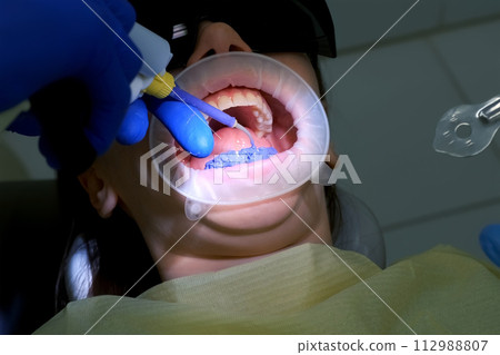 Dentist is applying blue acid on woman's teeth before installing veneers. Dentist is applying blue acid on woman's teeth before installing veneers. 112988807