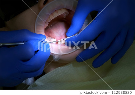 Dentist puts thread to stop the bleeding between the tooth and gum of patient. Dentist puts thread to stop the bleeding between the tooth and gum of patient. 112988820