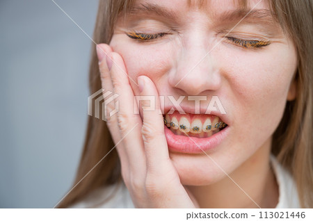 Close-up portrait of a red-haired girl suffering from pain due to braces. Young woman corrects bite with orthodontic appliance. 113021446