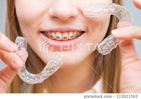 Woman with braces on her teeth holding and removable transparent aligners.  113021503