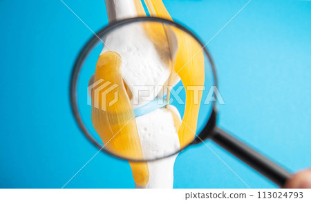 Medical mockup of a knee joint under a magnifying glass on a blue background. Knee ligament rupture and sprain concept. Knee fracture, close-up 113024793