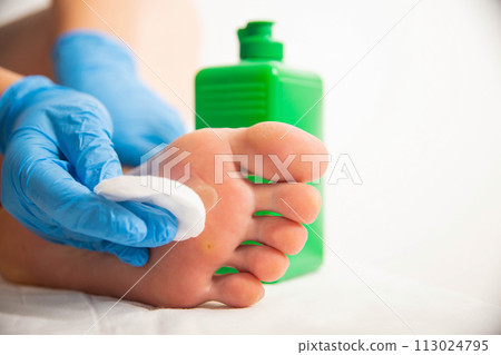 The doctor uses a special liquid to burn a removed callus on the foot. Surgical removal of calluses and warts, close-up The doctor uses a special liquid to burn a removed callus on the foot. Surgical removal of calluses and warts, close-up 113024795